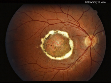 Color fundus photo from a patient with North Carolina Macular Dystrophy